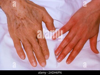 Anemia Skin Rash Pictures