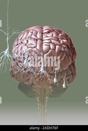 Alzheimer's disease. Conceptual computer artwork of a brain affected by Alzheimer's disease. The condition causes the death of brain cells (seen enlar Stock Photo