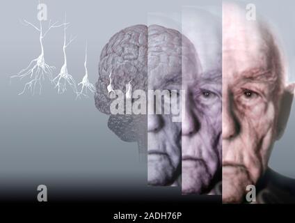 Alzheimer's disease. Conceptual computer artwork showing the brain of an elderly man affected by Alzheimer's disease. The condition causes the death o Stock Photo
