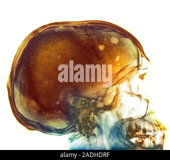 Bone marrow cancer. Coloured X-ray of the skull of a patient with myeloma (bone marrow cancer). Malignant (cancerous) lesions in the bone are yellow a Stock Photo