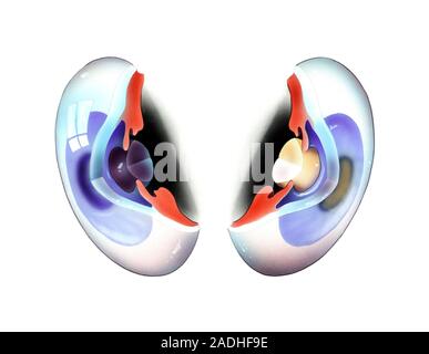 Cataract. Artwork of two eyes, one with a cataract (right). Cataract is a condition in which the lens of the eye loses its transparency. The lens of t Stock Photo