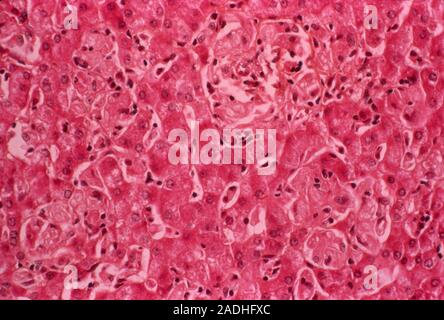 Gaucher's disease. Light micrograph of a section through a human liver with Gaucher's disease. It is a genetic disorder (autosomal recessive) that res Stock Photo