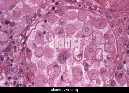 Gaucher's disease. Light micrograph of a section through the spleen of a patient with Gaucher's disease. This is an inherited metabolic disorder in wh Stock Photo
