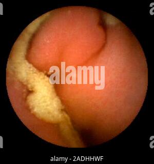 Intussusception of the jejunum, pill camera view. Intussusception is the prolapse of one part of the intestines into the part in front of it, in the s Stock Photo