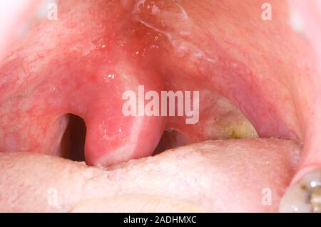 uvula swollen after tonsillectomy