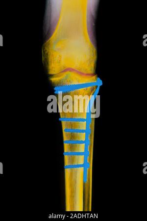 Fractured tibia. Coloured X-ray of metal pins holding a fractured tibia (lower leg bone) in place while it heals. Metal pins are used when there is a Stock Photo