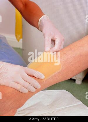 Hydrocolloid dressing. The gloved hands of a medical worker apply a hydrocolloid dressing called Granuflex to the leg of a patient. Hydrocolloid dress Stock Photo
