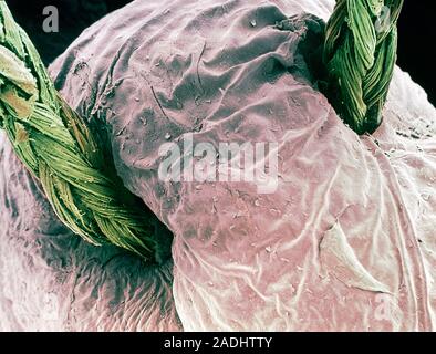 Suture. Coloured scanning electron micrograph (SEM) of a suture (green) through the skin. A suture is the thread used by surgeons to close wounds and Stock Photo