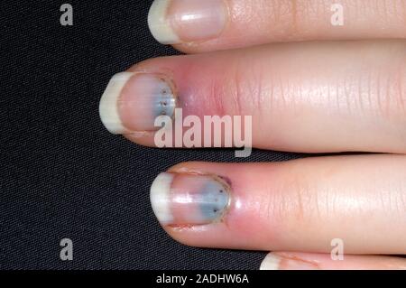 Bleeding under finger nails. Blood (dark areas) under the fingernails of a  22-year-old woman. Her fingers were crushed by the closing of a car door. T  Stock Photo - Alamy