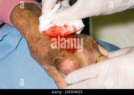 MODEL RELEASED. Dressing a hand wound. Image 1 of 5. Nurse cleaning the lacerated hand of a 89-year-old woman. The patient has been on long-term stero Stock Photo
