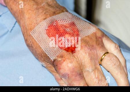 MODEL RELEASED. Dressing a hand wound. Image 2 of 5. Gauze dressing being applied to the lacerated hand of a 89-year-old woman. The patient has been o Stock Photo