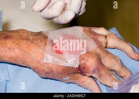 MODEL RELEASED. Dressing a hand wound. Image 3 of 5. Gauze dressing being applied to the lacerated hand of a 89-year-old woman. The patient has been o Stock Photo