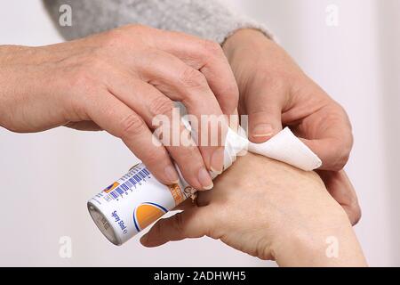 MODEL RELEASED. Dressing a hand wound. Carer cleansing a patient's injured hand with an antiseptic spray before applying a dressing. Stock Photo
