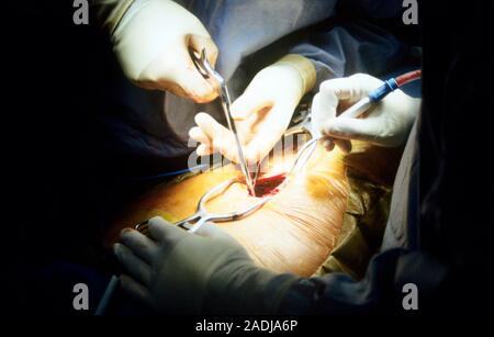 Spinal surgery. Orthopaedic surgeon (upper centre) using a heavy-duty set of bone forceps (a rongeur) to remove bone from the spine (a procedure known Stock Photo