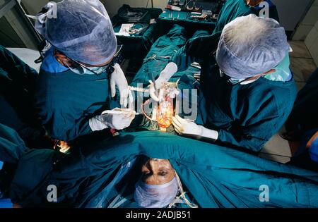 Heart surgery. Surgeons conducting coronary bypass surgery on a fully-conscious patient. Rather than a general anaesthetic, the patient has been given Stock Photo