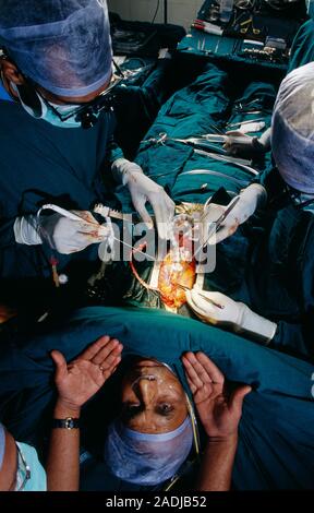 Heart surgery. Surgeons conducting coronary bypass surgery on a fully-conscious patient. Rather than a general anaesthetic, the patient has been given Stock Photo