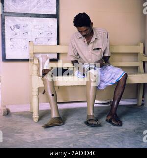 Prosthetic leg. Man fitting a new lower leg prosthesis. Correct fitting of a prosthesis is essential to help the amputee regain full mobility. Photogr Stock Photo