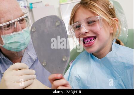 Plaque detection. Girl looking in a mirror after using a plaque disclosing tablets to show up areas of plaque on her teeth. A dentist is standing next Stock Photo