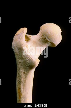 Photograph of the right human femur (thigh bone), showing a posterior view of the proximal end of the long bone which supports the femoral trochanter Stock Photo