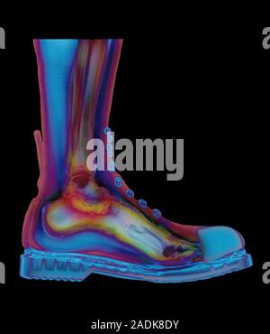Foot in boot. Coloured X-ray of a man's foot seen in side view, wearing a Doc Marten boot. The boot has a steel cap at the toes. Bones and soft tissue Stock Photo