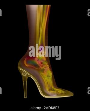 Foot in shoe. Coloured X-ray of a woman's foot seen in side view, wearing a high-heel shoe. In this shoe the foot is forced to rest mainly on its toes Stock Photo
