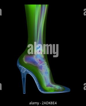 Foot in shoe. Coloured X-ray of a woman's foot seen in side view, wearing a high-heel shoe. In this shoe the foot is forced to rest mainly on its toes Stock Photo