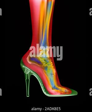 Foot in shoe. Coloured X-ray of a woman's foot seen in side view, wearing a high-heel shoe. In this shoe the foot is forced to rest mainly on its toes Stock Photo