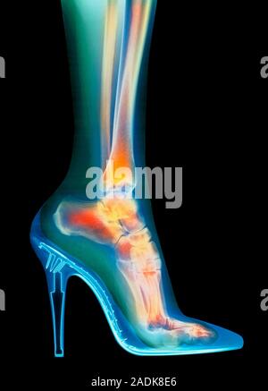 Foot in shoe. Coloured X-ray of a woman's foot seen in side view, wearing a high-heel shoe. In this shoe the foot is forced to rest mainly on its toes Stock Photo