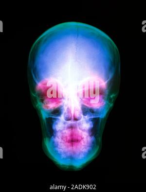 Human skull. Coloured X-ray of a human skull, seen from the front. At top is the rounded cranium which houses the brain. On the floor of the orbits (e Stock Photo