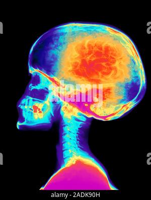Human skull with brain. Coloured computer-enhanced X-ray of the human skull in side view, with a healthy brain superimposed on it. The brain fits tigh Stock Photo