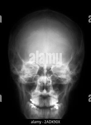 Human skull. X-ray of a human skull, seen from the front. At top is the rounded cranium which houses the brain. Teeth are seen in the upper and lower Stock Photo