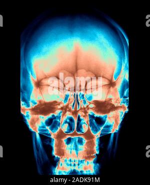 Skull. Coloured X-ray of a healthy human skull seen from the front. Prominent between the large orbits that hold the eyes are the facial sinuses. Thes Stock Photo