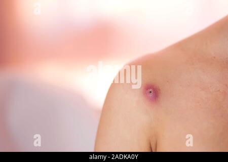 Skin of woman with big and painfull furuncle. People, medicine and skincare concept Stock Photo