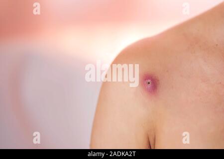 Skin of woman with big and painfull furuncle. People, medicine and skincare concept Stock Photo