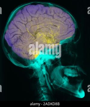 Brain on skull X-ray. Coloured composite image of a sectioned brain (purple) on an X-ray of a skull (green). The front of the skull is at right. Blood Stock Photo
