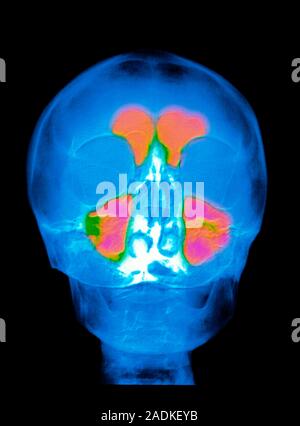 Sinuses. Coloured X-ray image of a person's skull with the healthy paranasal sinuses highlighted, as seen from the front. The two large maxillary sinu Stock Photo