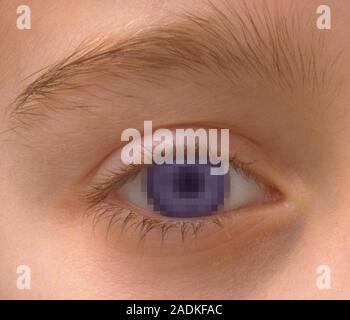 Pixellated eye, computer artwork. This could represent artificial vision or impaired sight. Stock Photo