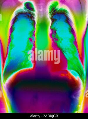 Healthy lungs and heart. Coloured X-ray of the chest of an adult male, showing healthy lungs and heart. The two lung fields (upper left and right, blu Stock Photo