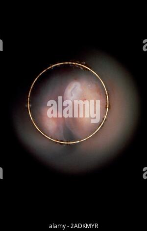 Endoscopic image of the human foetus in vivo, after 7 weeks, showing the developing outer ear placed low on the neck (centre-top of image circle). The Stock Photo