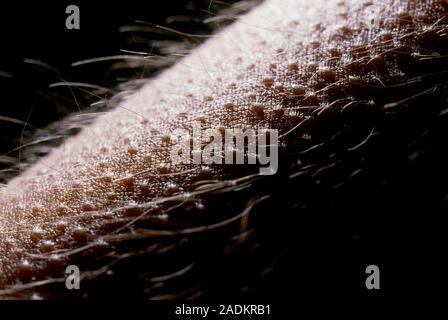 Macrophotograph of the skin on the arm of a young male human showing goose-flesh on the outer cornified (keratinised) epidermis. The skin surface show Stock Photo
