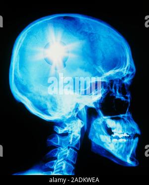 Idea. Conceptual image of a glowing light bulb superimposed on an X-ray of a human skull in profile, representing an idea or thought. Stock Photo
