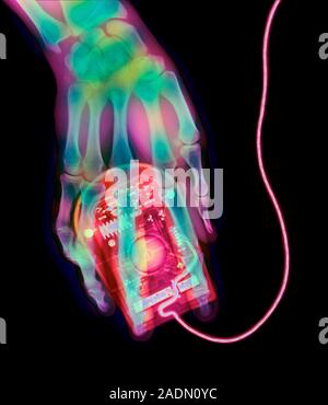 Computer mouse. Coloured X-ray of a computer mouse being held and operated by a human hand. A mouse" is a computer peripheral device. Its attachment Stock Photo