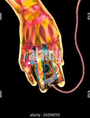 Computer mouse. Coloured X-ray of a computer mouse being held and operated by a human hand. A 'mouse' is a computer peripheral device. Its attachment Stock Photo