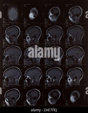 Magnetic resonance image of the female brain Stock Photo