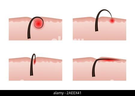 Ingrown hairs after depilation. Vector illustration. Inflammation of the skin and epidermis. Stock Vector