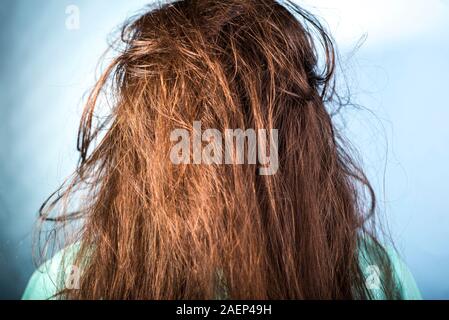 portrait of a girl with dirty, greasy, disheveled hair and problematic scalp.  On a blue background. Dermatological hair disease, dandruff, seborrheic  Stock Photo - Alamy
