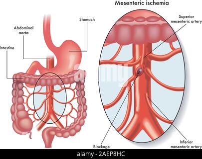 Medical illustration showing a mesenteric  ischemia also called intestinal infarction, a blockage of blood circulation, affecting  the mesenteric arte Stock Vector