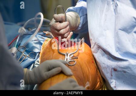 Surgeons at an NHS Hospital perform a knee operation, known as an Arthroplasty, to repair the damaged joint with an artificial one. Stock Photo