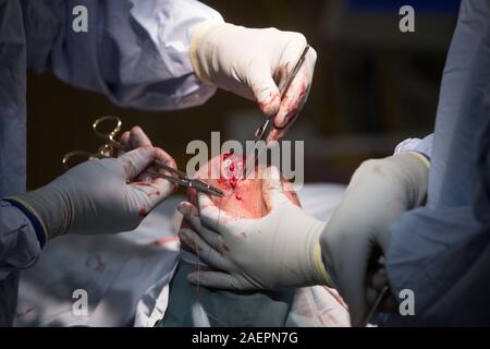 Surgeons at an NHS Hospital perform a knee operation, known as an Arthroplasty, to repair the damaged joint with an artificial one. Stock Photo