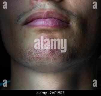 Acne pimples on the face of a young man Stock Photo - Alamy